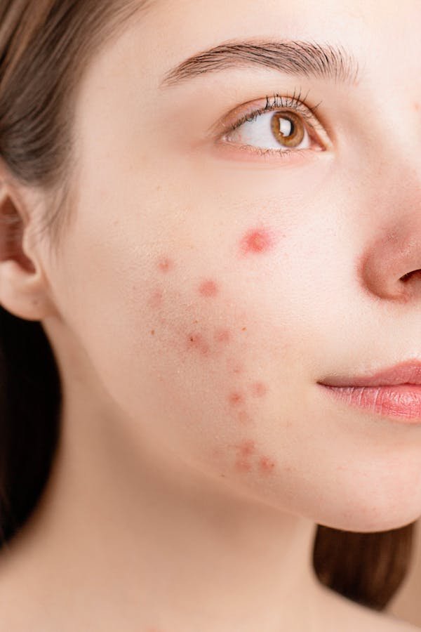 Petit bouton rouge : 5 étapes pour une peau éclatante